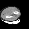 SPORK, NICO - 22.03.1976 - 02.08.2022 - CT obere Extremität - 17:56:57